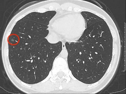 病例(14例)阐述肺部结节的ct诊断策略