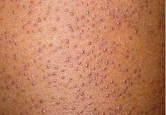 毛周角化症怎么治