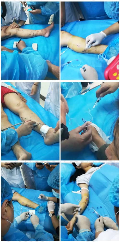 洛阳市第一中医院下肢静脉曲张及血管瘤手把手教学简报