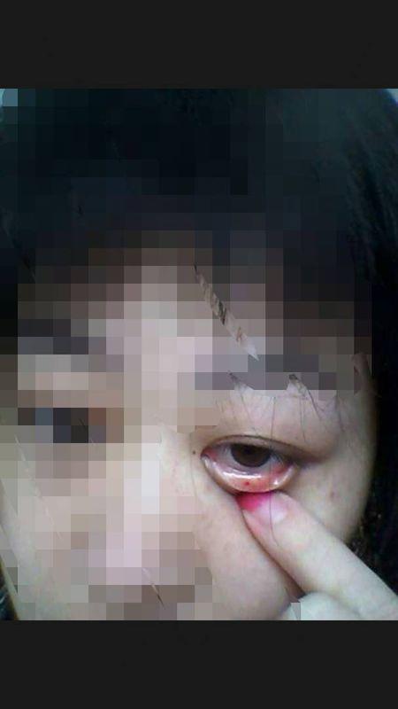 你好,我是红斑狼疮患者,女 26岁,现在眼睛下