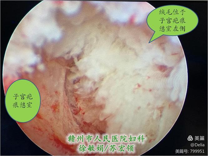 超声监护下宫腔镜电切术治疗子宫疤痕妊娠