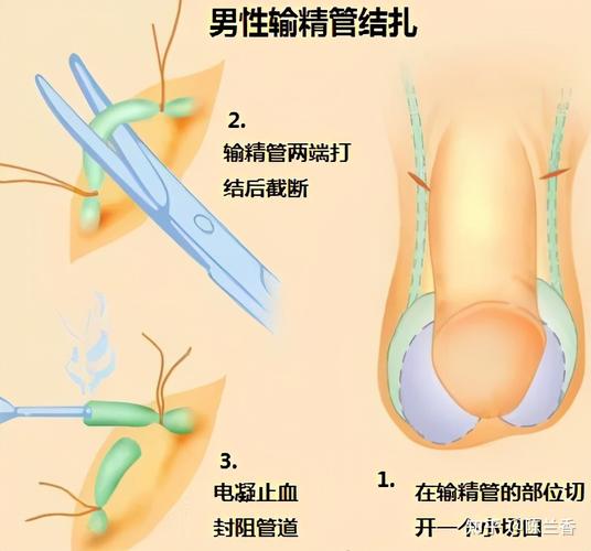 如何看待媒体文章《一个 24 岁的男生,决定做结扎手术