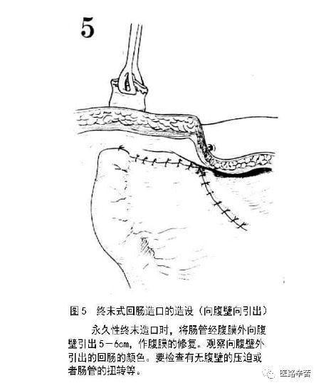 图解手术回肠及结肠造口术