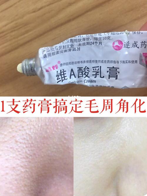 10年遗传毛周角化16615支药膏搞定了 前段时间早上起来化妆_清洁