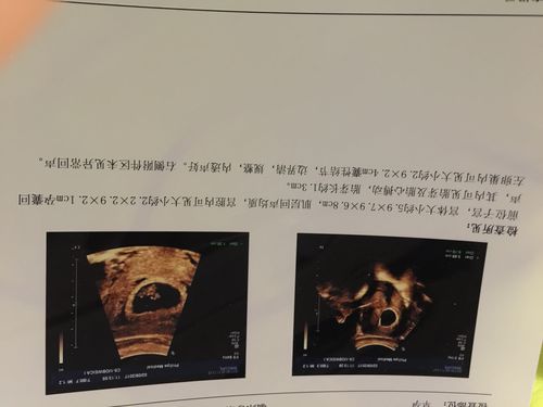 孕囊大小决定男宝女宝吗?有的说圆形就是女宝,长形是男宝.是这