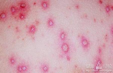 斑疹伤寒诊断标准有哪些