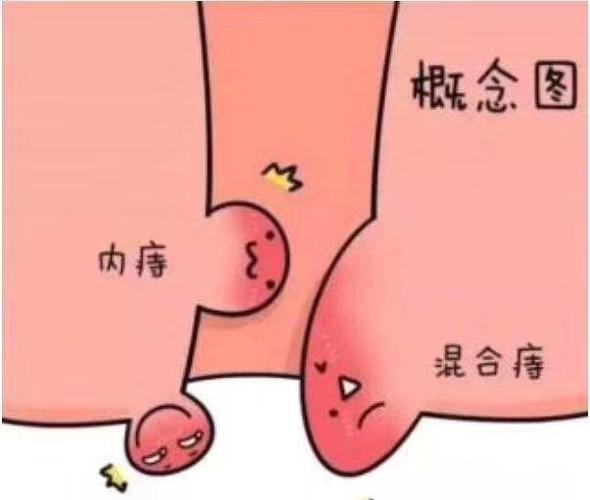 得了痔疮怎么办?