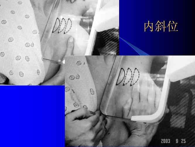 乳腺癌的影像诊断