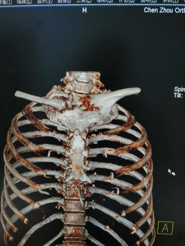 女性,54岁,胸骨柄突起畸形数年,偶尔疼痛