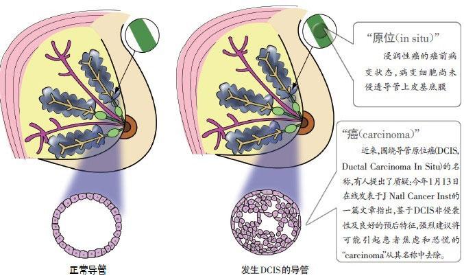 乳腺导管原位癌治疗的困惑