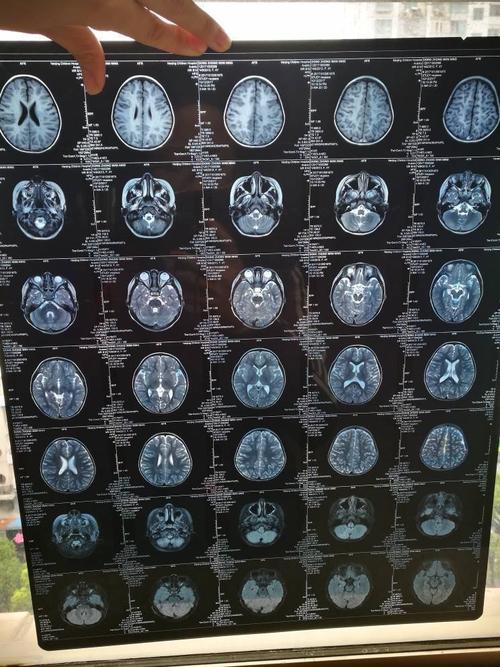 【着急求助!】4岁半宝宝双侧颞部脑外间隙增宽 双侧脑室饱满,常说头晕