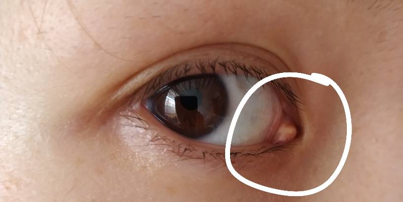 向ta提问私信ta  展开全部 这是眼睛里头长的息肉,每个人的眼睛里头