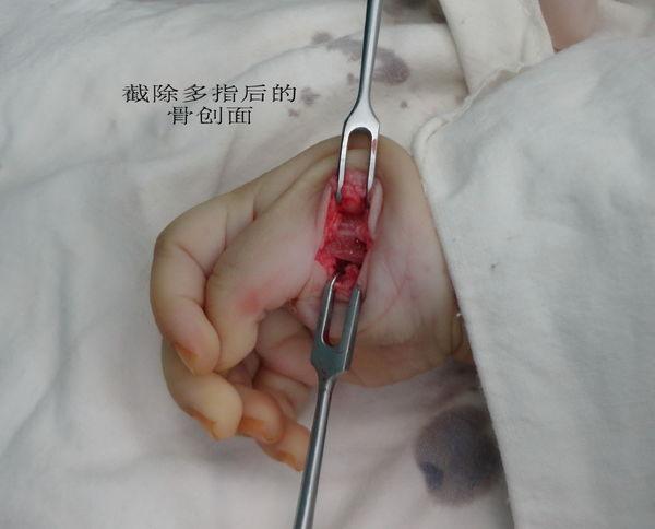 小婴儿多指切除术全过程