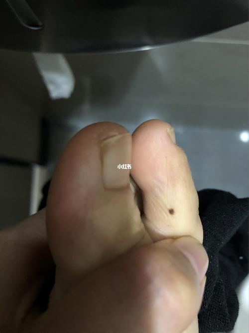 脚上长了个痣_医疗健康_医疗健康其他