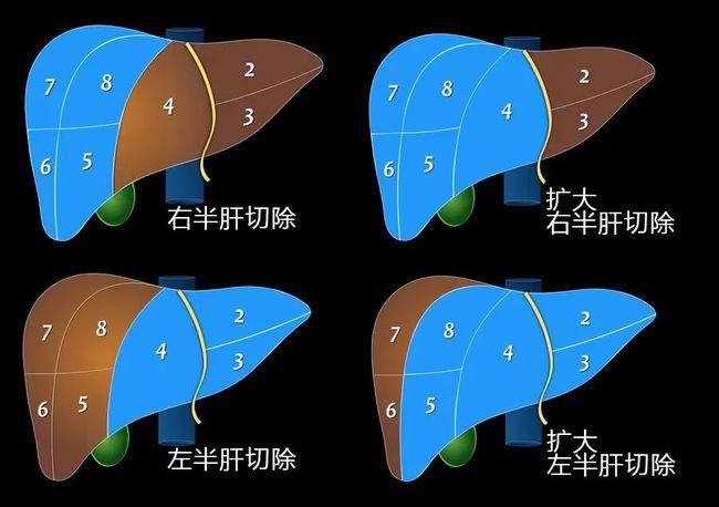 肝脏切除术示意图右后叶切除术:s6,s7右前叶切除术:s5,s8左内叶切除术
