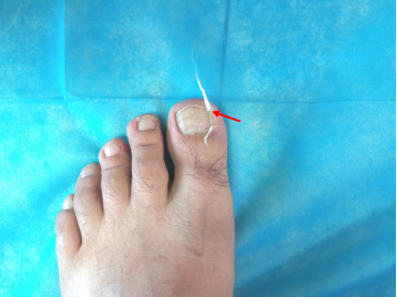 得了甲沟炎怎么办? 医生教你居家治疗