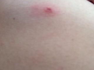 胸部周围长了三个小水泡不疼不痒一碰就