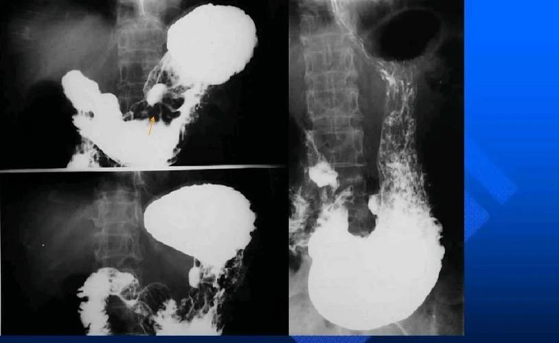 关于影像科的造影检查项目之上消化道造影