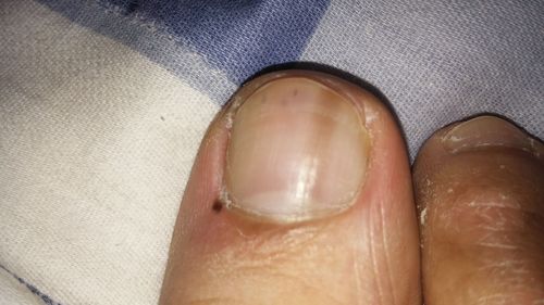 左右脚大拇指出现几道短的黑色竖线条,不通不痒,到底什么原因啊?