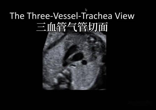 正常篇:三血管气管切面——胎儿心超最重要的切面