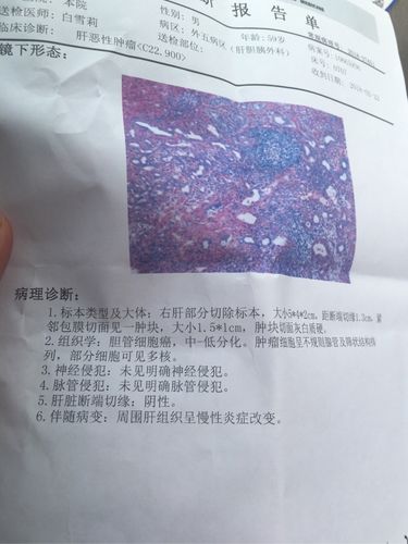 父亲确诊为胆管细胞癌,有经验的朋友传授一下,后期怎么护理,现在这个