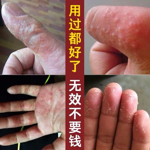 治手足脚癣藓鹅掌风湿疹止痒去根水泡型干裂脱皮真菌感染专用药膏