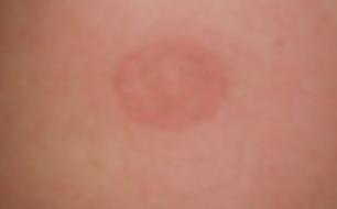 有个朋友身上长了如图一样的东西,还痒,外圈是红色.里面是白色