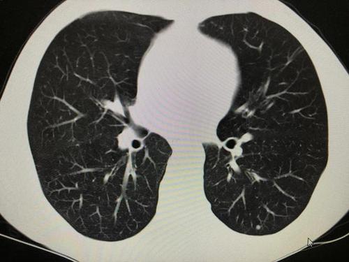 说说肺结节那些事儿