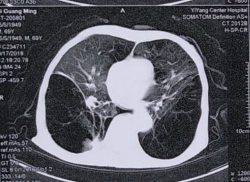 1月后(9-17)复查胸部ct,右下肺大泡较前明显复张.