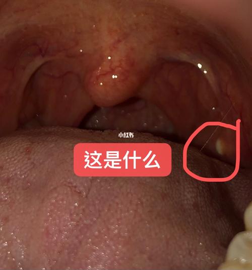嗓子,扁桃体白点_扁桃体_上火_手电筒_草莓_手机_医疗
