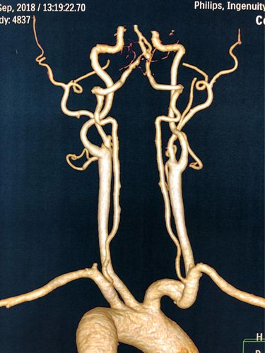 双侧椎动脉v4段狭窄介入治疗一例