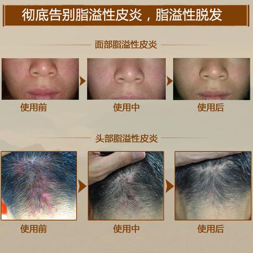 面部脂溢性皮炎的治疗方法