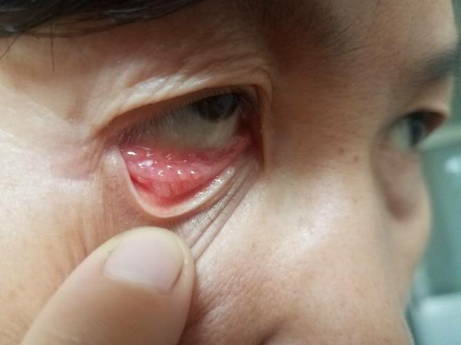 眼睛里边有水泡 怎么回事 求大神