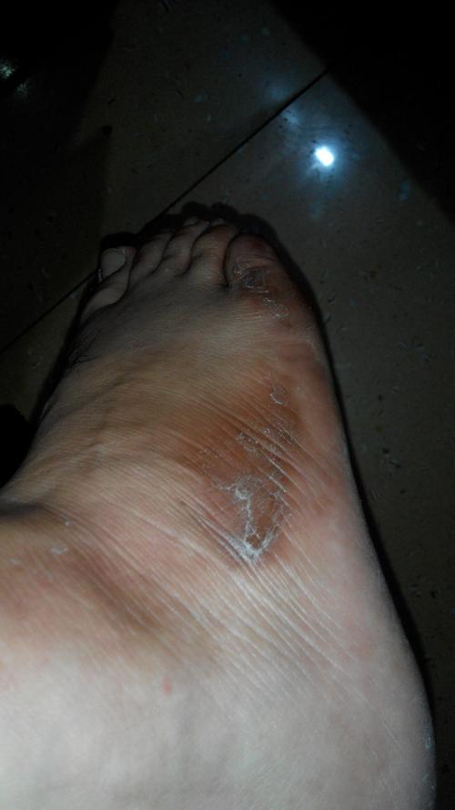 脚踝下有一片像癣的东西 左右脚同个地方都有 有图有真相