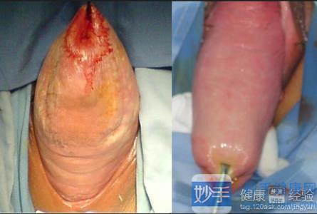 比如,胃下垂,大肠下垂,睾丸下垂引起的疝气等,当然还有子宫下垂,这些
