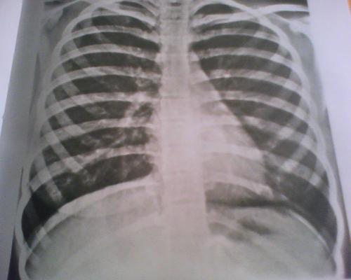 正常胸片后前位心脏偏左还是右?为什么?