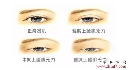 转载举睑汤治眼肌重症肌无力11例痊愈10例