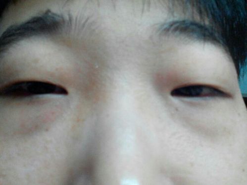 我的眼睛和鱼泡眼还有眼袋有什么好的办法改善么