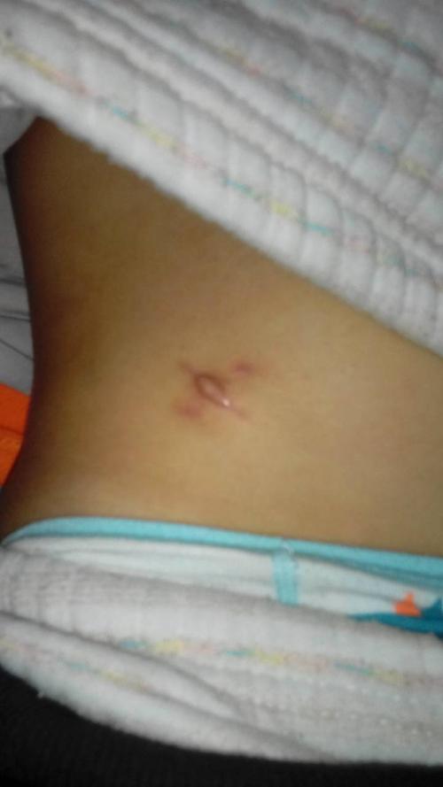 10月21做的急性阑尾炎并穿孔至今有25天伤口有鼓出来.