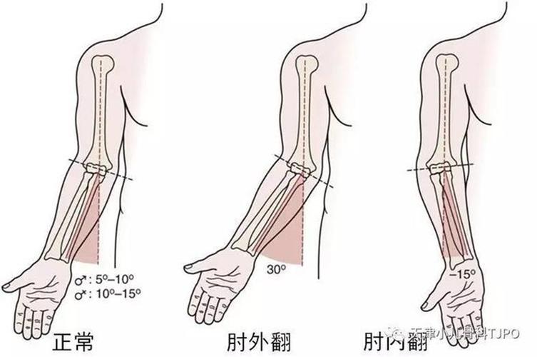 关于肘内(外)翻