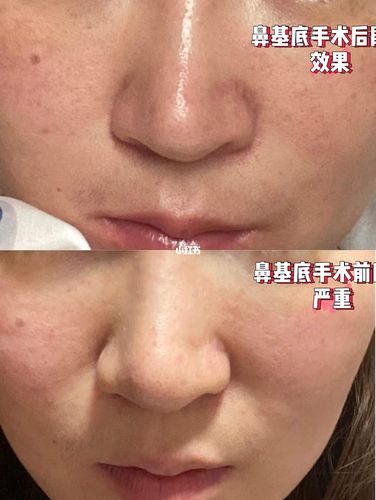 鼻基底手术_化妆_减龄_变美_美妆_医美整形