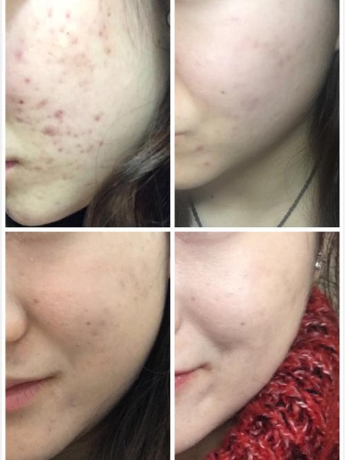 祛痘干货贴后有对比慎入哦