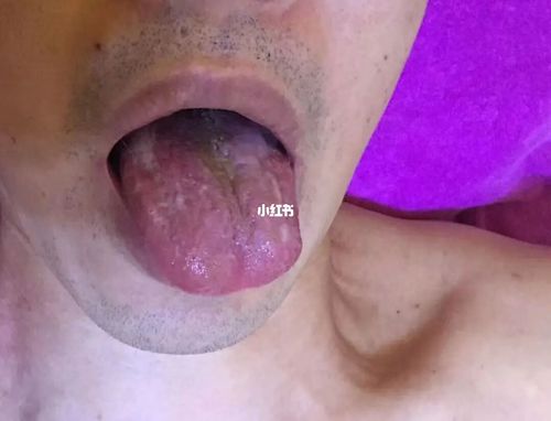 几个患者舌苔一个比一个差_舌苔_脾虚_医疗健康_医疗