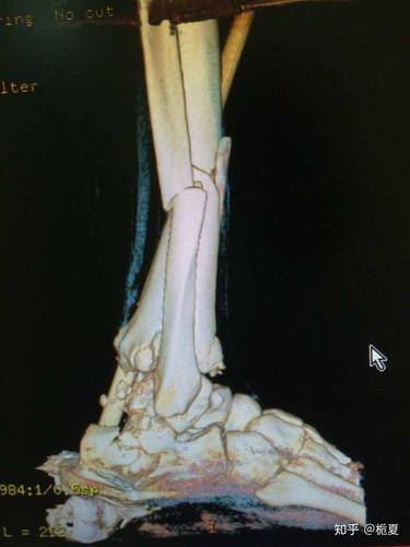 看一下三维重建的片子