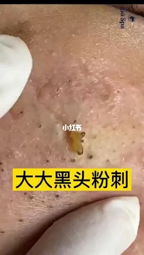去黑头神器_去黑头神器_去黑头_黑头粉刺_植物面膜