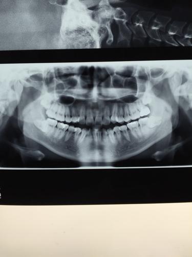 大家别害怕,这只是几张牙齿的x光片,下面智齿,水平长出来啦,如果拔除