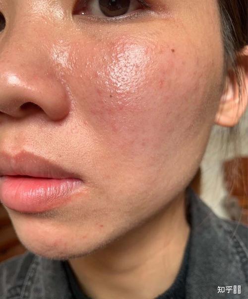 得了激素脸,怎么办啊?