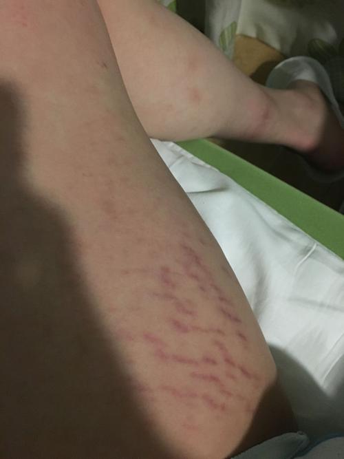 这是不是肥胖纹?两腿都有 两个胳肢窝也有