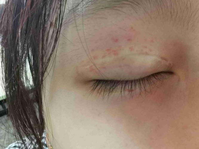 眼睛哭完突然变成这个样子了,眼皮附近都是小红点,两个眼皮下面也都
