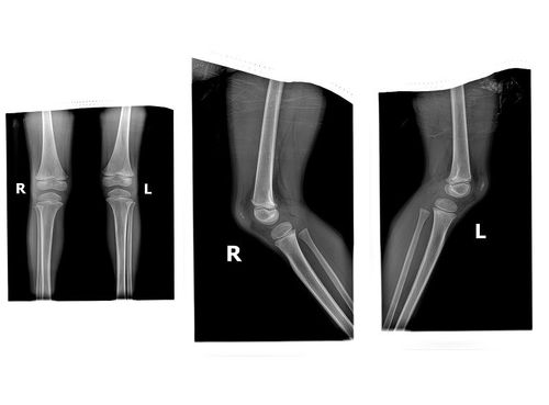 ped4042:髌骨会诊